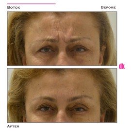 BOTOX - Frown Lines - Before and After