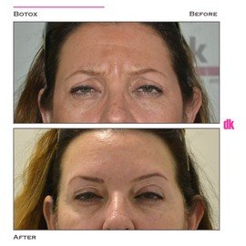 BOTOX - Frown Lines - Before and After