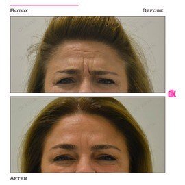 BOTOX - Frown Lines - Before and After