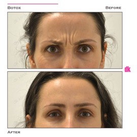BOTOX - Frown Lines - Before and After