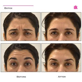 BOTOX - Frown Lines - Before and After