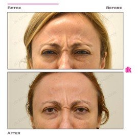 BOTOX - Frown Lines - Before and After