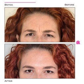 BOTOX - Frown Lines - Before and After