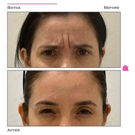 BOTOX - Frown Lines - Before and After