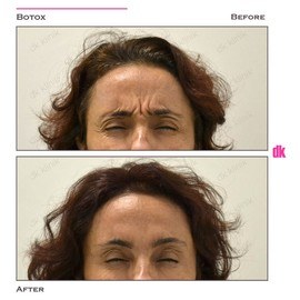 BOTOX - Frown Lines - Before and After