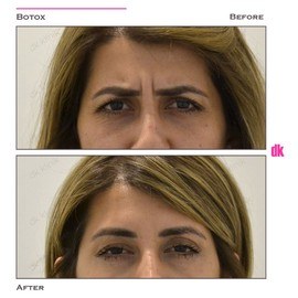 BOTOX - Frown Lines - Before and After