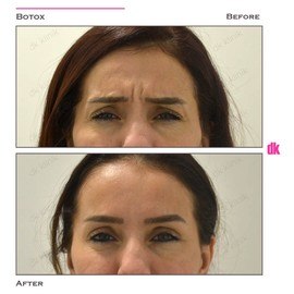 BOTOX - Frown Lines - Before and After