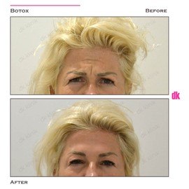 BOTOX - Frown Lines - Before and After