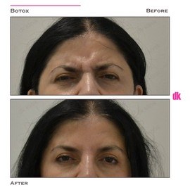 BOTOX - Frown Lines - Before and After