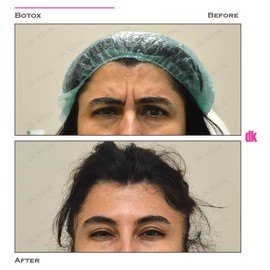 BOTOX - Frown Lines - Before and After