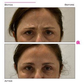 BOTOX - Frown Lines - Before and After