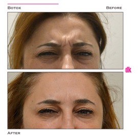 BOTOX - Frown Lines - Before and After