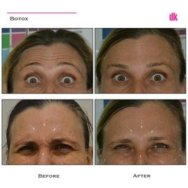 BOTOX - Frown Lines - Before and After