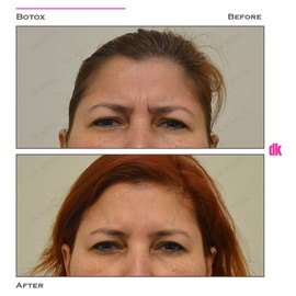BOTOX - Frown Lines - Before and After