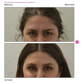 BOTOX - Frown Lines - Before and After