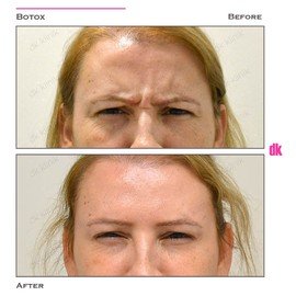 BOTOX - Frown Lines - Before and After