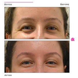 BOTOX - Frown Lines - Before and After