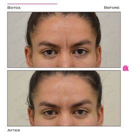 BOTOX - Frown Lines - Before and After