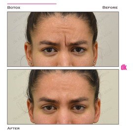 BOTOX - Frown Lines - Before and After