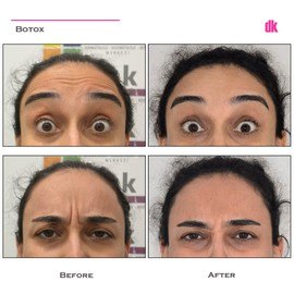 BOTOX - Frown Lines - Before and After