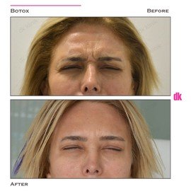 BOTOX - Frown Lines - Before and After