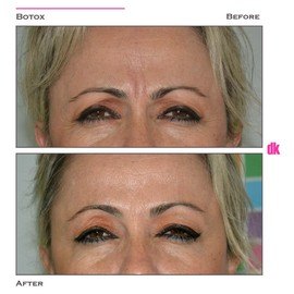 BOTOX - Frown Lines - Before and After