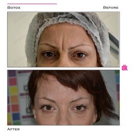 BOTOX - Frown Lines - Before and After
