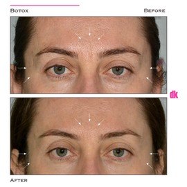 BOTOX - Frown Lines - Before and After