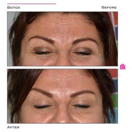 BOTOX - Frown Lines - Before and After