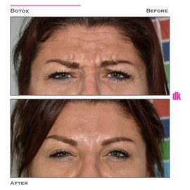 BOTOX - Frown Lines - Before and After
