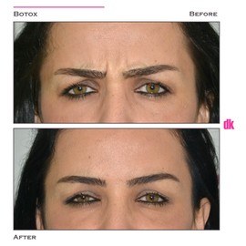 BOTOX - Frown Lines - Before and After