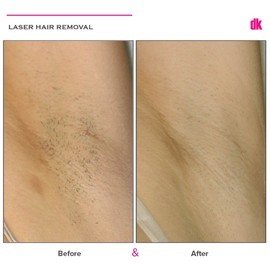 LASER HAIR REMOVAL - Female - Before and After
