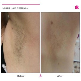 LASER HAIR REMOVAL - Female - Before and After