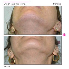 LASER HAIR REMOVAL - Female - Before and After