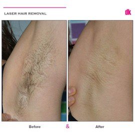 LASER HAIR REMOVAL - Female - Before and After