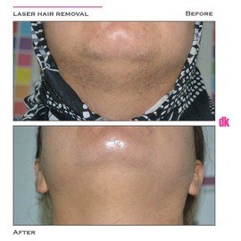LASER HAIR REMOVAL - Female - Before and After