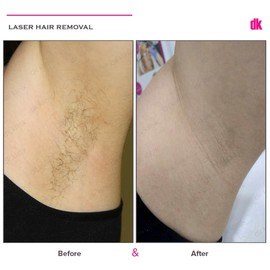 LASER HAIR REMOVAL - Female - Before and After
