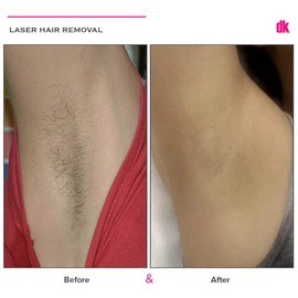 LASER HAIR REMOVAL - Female - Before and After