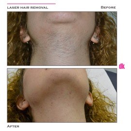 LASER HAIR REMOVAL - Female - Before and After