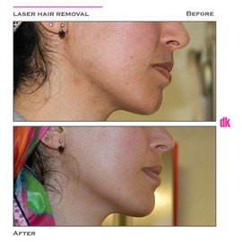 LASER HAIR REMOVAL - Female - Before and After