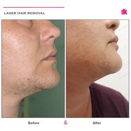 LASER HAIR REMOVAL - Female - Before and After