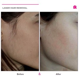 LASER HAIR REMOVAL - Female - Before and After