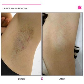 LASER HAIR REMOVAL - Female - Before and After