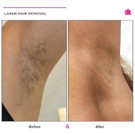 LASER HAIR REMOVAL - Female - Before and After