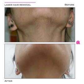 LASER HAIR REMOVAL - Female - Before and After