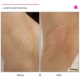 LASER HAIR REMOVAL - Female - Before and After
