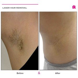 LASER HAIR REMOVAL - Female - Before and After