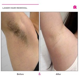 LASER HAIR REMOVAL - Female - Before and After