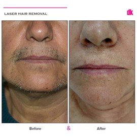 LASER HAIR REMOVAL - Female - Before and After