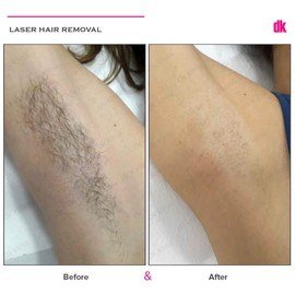 LASER HAIR REMOVAL - Female - Before and After